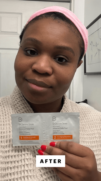 Cruel after applying the Dr. Dennis Gross Alpha Beta Universal Daily Peel